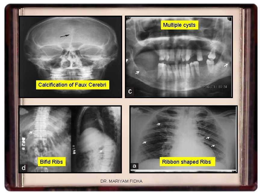 Multiple cysts Calcification of Faux Cerebri Bifid Ribs Ribbon shaped Ribs DR. MARIYAM FIDHA