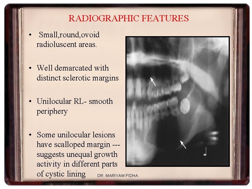 RADIOGRAPHIC FEATURES • Small, round, ovoid radioluscent areas. • Well demarcated with distinct sclerotic