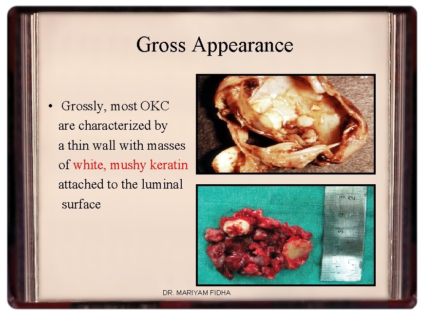 Gross Appearance • Grossly, most OKC are characterized by a thin wall with masses