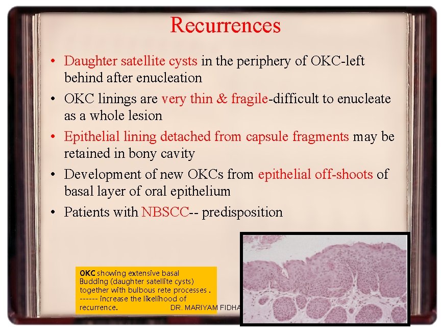 Recurrences • Daughter satellite cysts in the periphery of OKC-left behind after enucleation •