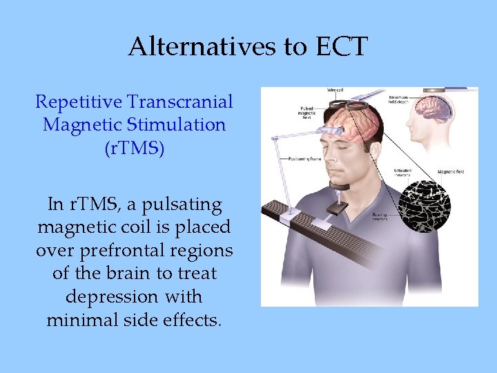 Alternatives to ECT Repetitive Transcranial Magnetic Stimulation (r. TMS) In r. TMS, a pulsating