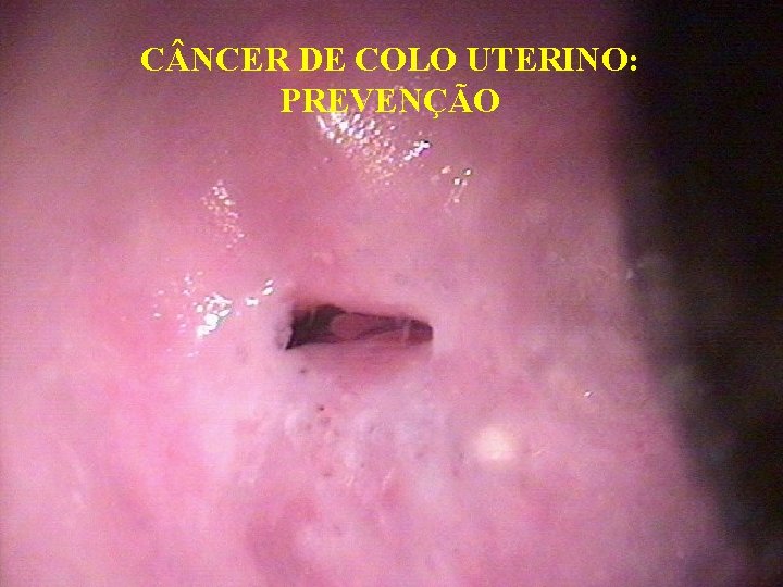 C NCER DE COLO UTERINO: PREVENÇÃO 