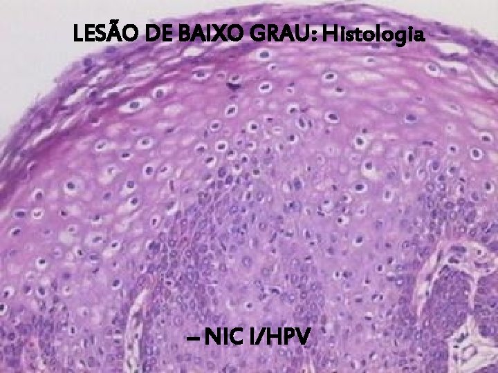 LESÃO DE BAIXO GRAU: Histologia – NIC I/HPV 