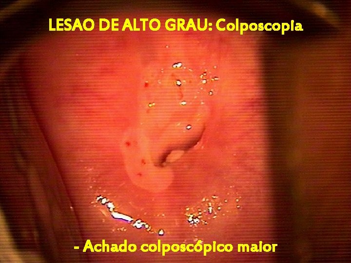 LESAO DE ALTO GRAU: Colposcopia - Achado colposcópico maior 