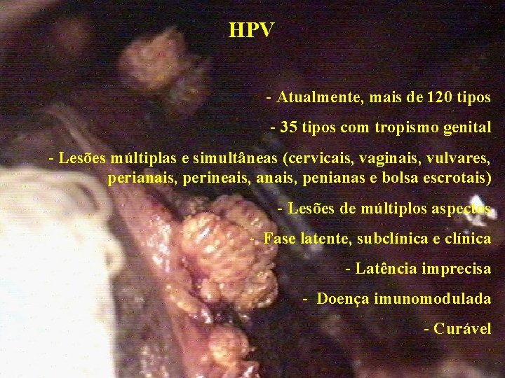 HPV - Atualmente, mais de 120 tipos - 35 tipos com tropismo genital -