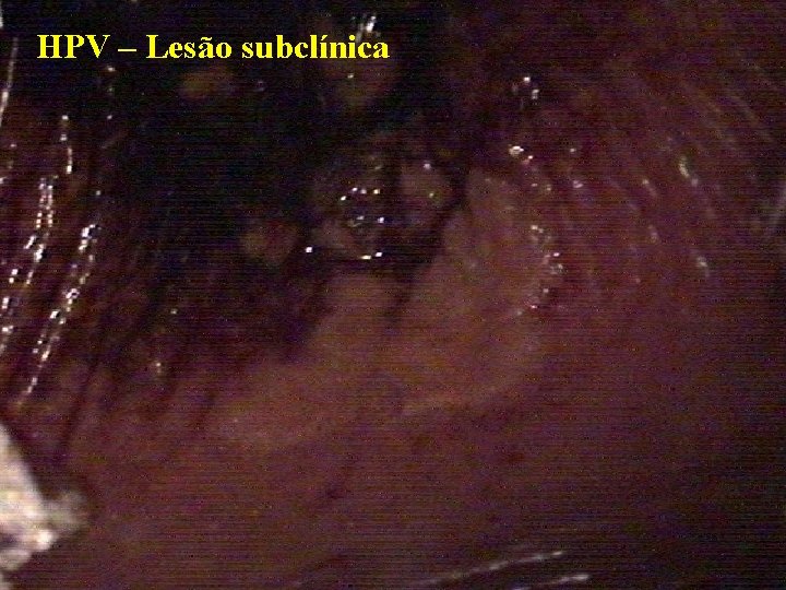 HPV – Lesão subclínica 