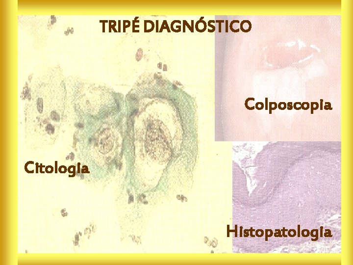 TRIPÉ DIAGNÓSTICO Colposcopia Citologia Histopatologia 