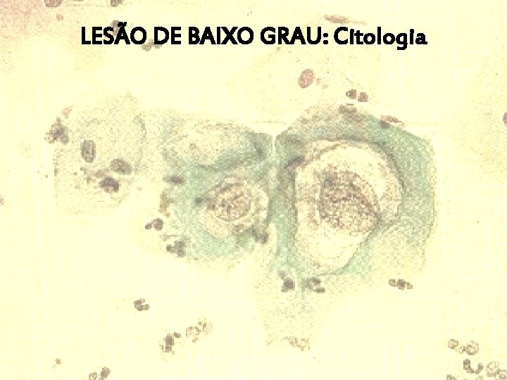 LESÃO DE BAIXO GRAU: Citologia 