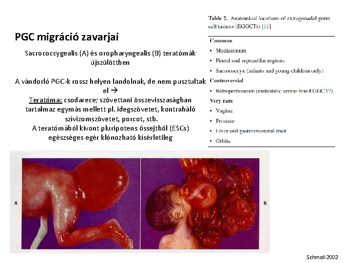 PGC migráció zavarjai Sacrococcygealis (A) és oropharyngealis (B) teratómák újszülöttben A vándorló PGC-k rossz