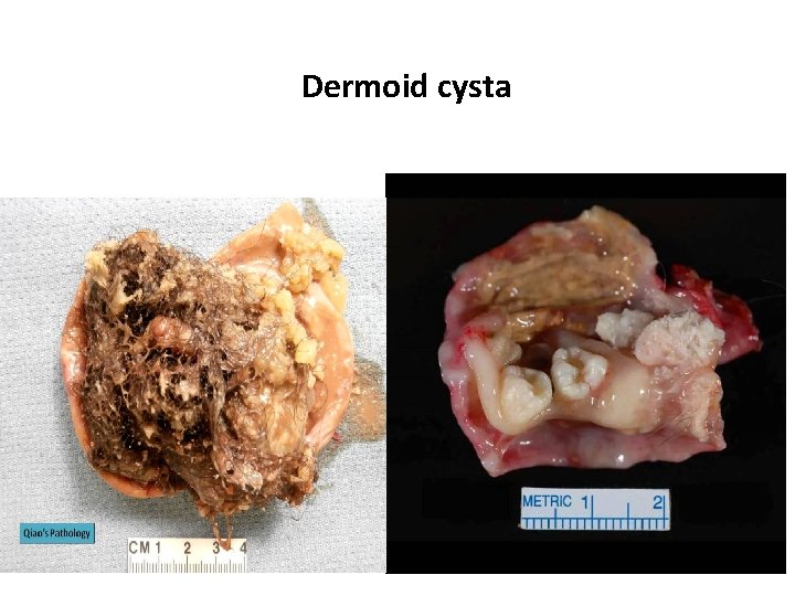 Dermoid cysta 