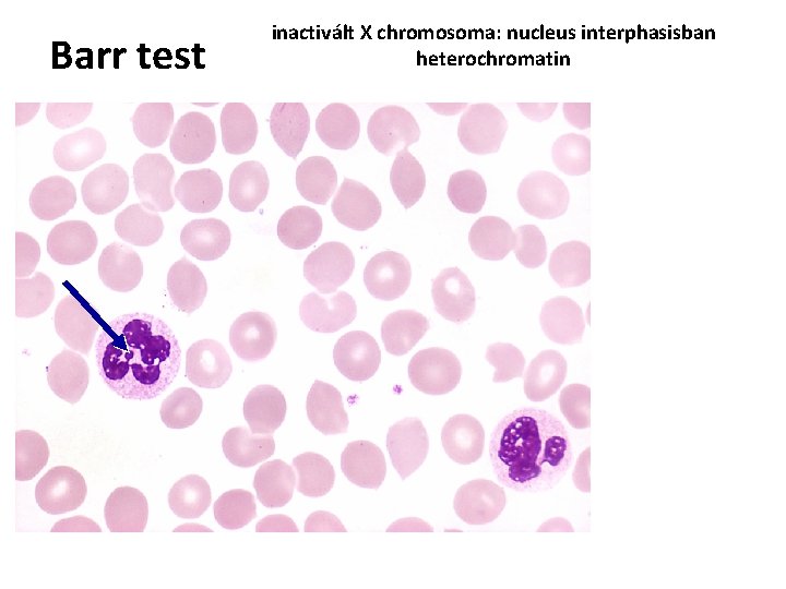 Barr test inactivált X chromosoma: nucleus interphasisban heterochromatin 