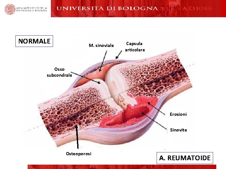 NORMALE M. sinoviale Capsula articolare Osso subcondrale Erosioni Sinovite Osteoporosi A. REUMATOIDE NORMALE M. sinoviale Capsula articolare Osso subcondrale Erosioni Sinovite Osteoporosi A. REUMATOIDE