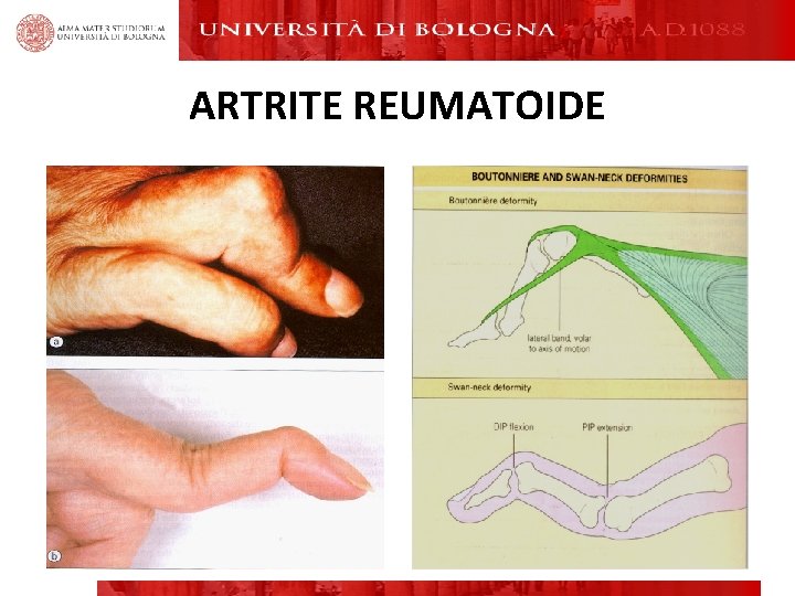 ARTRITE REUMATOIDE ARTRITE REUMATOIDE