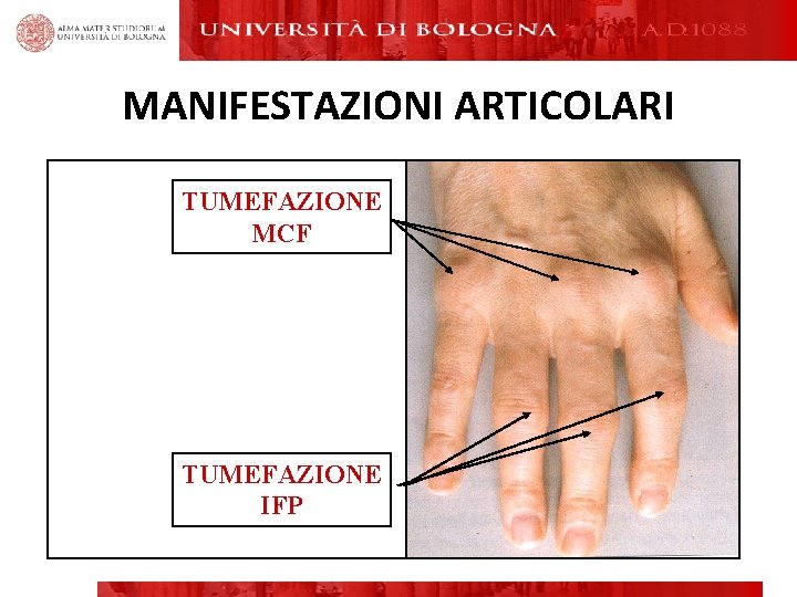MANIFESTAZIONI ARTICOLARI TUMEFAZIONE MCF TUMEFAZIONE IFP MANIFESTAZIONI ARTICOLARI TUMEFAZIONE MCF TUMEFAZIONE IFP