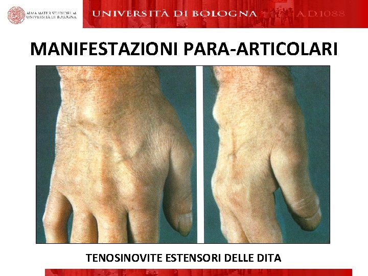 MANIFESTAZIONI PARA-ARTICOLARI TENOSINOVITE ESTENSORI DELLE DITA MANIFESTAZIONI PARA-ARTICOLARI TENOSINOVITE ESTENSORI DELLE DITA