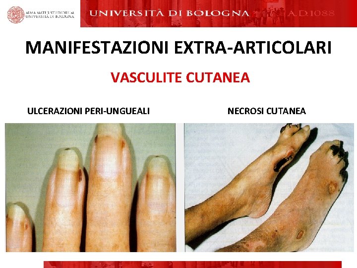 MANIFESTAZIONI EXTRA-ARTICOLARI VASCULITE CUTANEA ULCERAZIONI PERI-UNGUEALI NECROSI CUTANEA MANIFESTAZIONI EXTRA-ARTICOLARI VASCULITE CUTANEA ULCERAZIONI PERI-UNGUEALI NECROSI CUTANEA