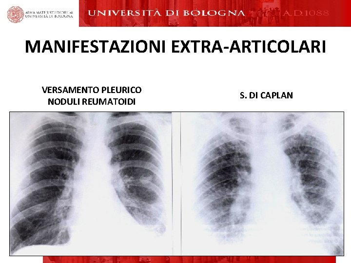 MANIFESTAZIONI EXTRA-ARTICOLARI VERSAMENTO PLEURICO NODULI REUMATOIDI S. DI CAPLAN MANIFESTAZIONI EXTRA-ARTICOLARI VERSAMENTO PLEURICO NODULI REUMATOIDI S. DI CAPLAN