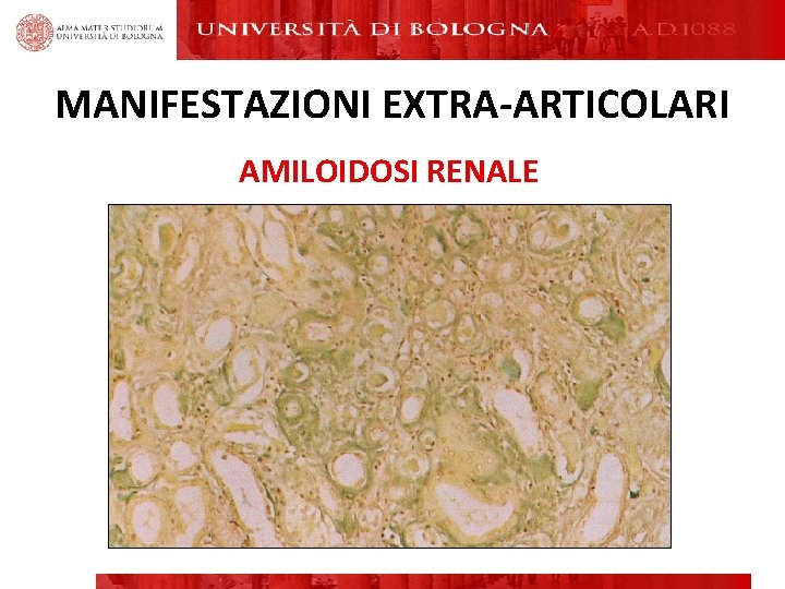 MANIFESTAZIONI EXTRA-ARTICOLARI AMILOIDOSI RENALE MANIFESTAZIONI EXTRA-ARTICOLARI AMILOIDOSI RENALE