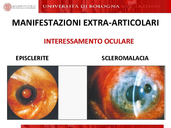 MANIFESTAZIONI EXTRA-ARTICOLARI INTERESSAMENTO OCULARE EPISCLERITE SCLEROMALACIA MANIFESTAZIONI EXTRA-ARTICOLARI INTERESSAMENTO OCULARE EPISCLERITE SCLEROMALACIA