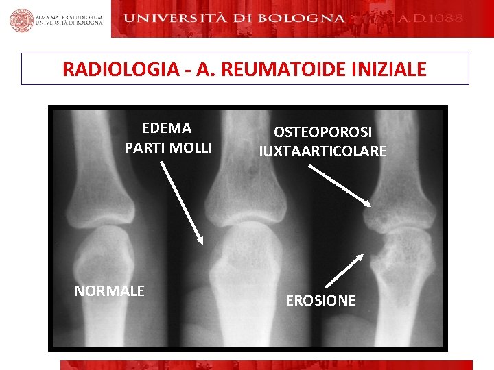 RADIOLOGIA - A. REUMATOIDE INIZIALE EDEMA PARTI MOLLI NORMALE OSTEOPOROSI IUXTAARTICOLARE EROSIONE DISLOCAZIONI E RADIOLOGIA - A. REUMATOIDE INIZIALE EDEMA PARTI MOLLI NORMALE OSTEOPOROSI IUXTAARTICOLARE EROSIONE DISLOCAZIONI E