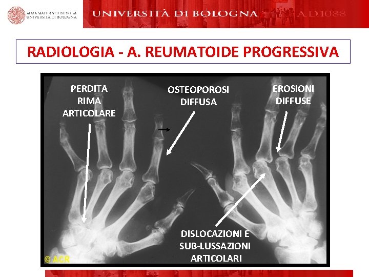 RADIOLOGIA - A. REUMATOIDE PROGRESSIVA PERDITA RIMA ARTICOLARE OSTEOPOROSI DIFFUSA DISLOCAZIONI E SUB-LUSSAZIONI ARTICOLARI RADIOLOGIA - A. REUMATOIDE PROGRESSIVA PERDITA RIMA ARTICOLARE OSTEOPOROSI DIFFUSA DISLOCAZIONI E SUB-LUSSAZIONI ARTICOLARI
