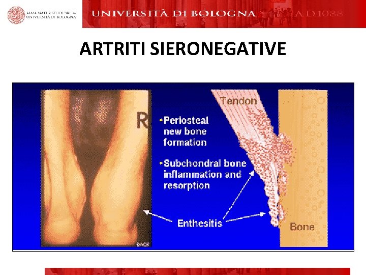 ARTRITI SIERONEGATIVE ARTRITI SIERONEGATIVE