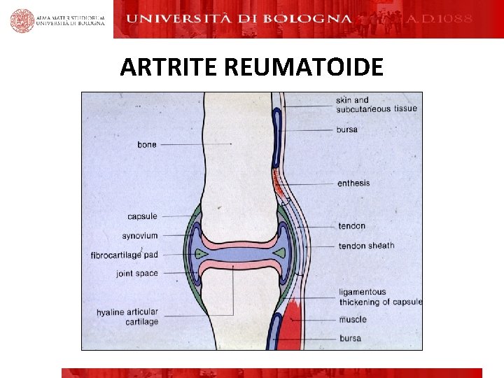 ARTRITE REUMATOIDE ARTRITE REUMATOIDE