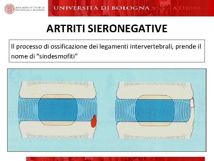 ARTRITI SIERONEGATIVE Il processo di ossificazione dei legamenti intervertebrali, prende il nome di “sindesmofiti” ARTRITI SIERONEGATIVE Il processo di ossificazione dei legamenti intervertebrali, prende il nome di “sindesmofiti”
