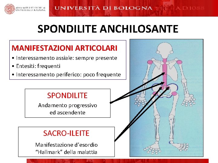 SPONDILITE ANCHILOSANTE MANIFESTAZIONI ARTICOLARI • Interessamento assiale: sempre presente • Entesiti: frequenti • Interessamento SPONDILITE ANCHILOSANTE MANIFESTAZIONI ARTICOLARI • Interessamento assiale: sempre presente • Entesiti: frequenti • Interessamento