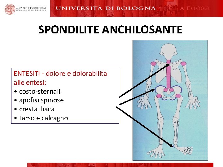SPONDILITE ANCHILOSANTE ENTESITI - dolore e dolorabilità alle entesi: • costo-sternali • apofisi spinose SPONDILITE ANCHILOSANTE ENTESITI - dolore e dolorabilità alle entesi: • costo-sternali • apofisi spinose