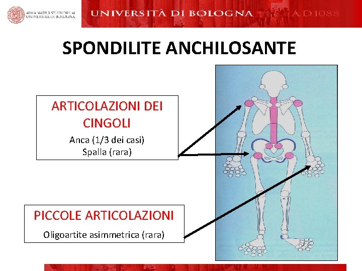 SPONDILITE ANCHILOSANTE ARTICOLAZIONI DEI CINGOLI Anca (1/3 dei casi) Spalla (rara) PICCOLE ARTICOLAZIONI Oligoartite SPONDILITE ANCHILOSANTE ARTICOLAZIONI DEI CINGOLI Anca (1/3 dei casi) Spalla (rara) PICCOLE ARTICOLAZIONI Oligoartite