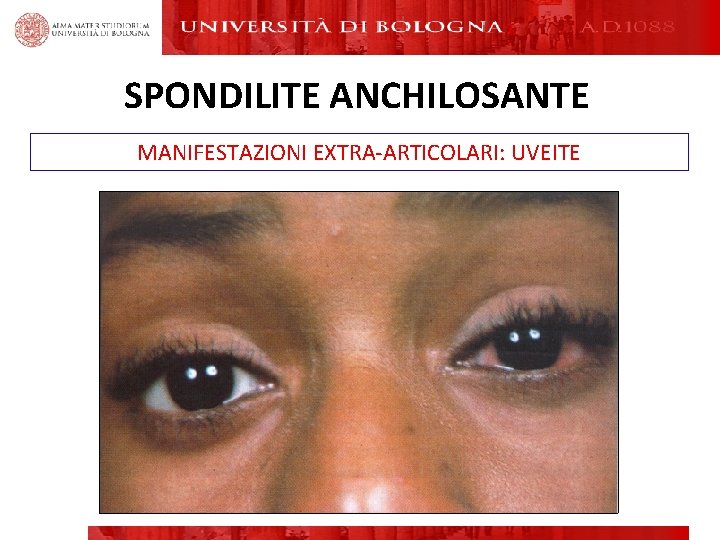 SPONDILITE ANCHILOSANTE MANIFESTAZIONI EXTRA-ARTICOLARI: UVEITE SPONDILITE ANCHILOSANTE MANIFESTAZIONI EXTRA-ARTICOLARI: UVEITE