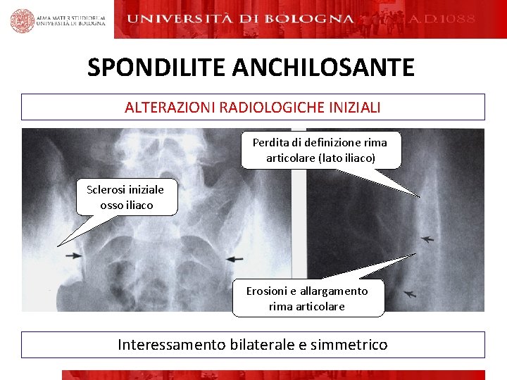 SPONDILITE ANCHILOSANTE ALTERAZIONI RADIOLOGICHE INIZIALI Perdita di definizione rima articolare (lato iliaco) Sclerosi iniziale SPONDILITE ANCHILOSANTE ALTERAZIONI RADIOLOGICHE INIZIALI Perdita di definizione rima articolare (lato iliaco) Sclerosi iniziale