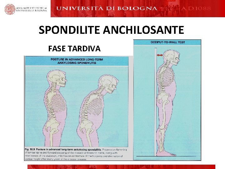 SPONDILITE ANCHILOSANTE FASE TARDIVA SPONDILITE ANCHILOSANTE FASE TARDIVA