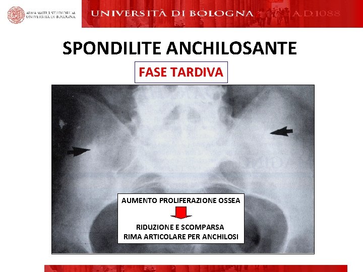SPONDILITE ANCHILOSANTE FASE TARDIVA AUMENTO PROLIFERAZIONE OSSEA RIDUZIONE E SCOMPARSA RIMA ARTICOLARE PER ANCHILOSI SPONDILITE ANCHILOSANTE FASE TARDIVA AUMENTO PROLIFERAZIONE OSSEA RIDUZIONE E SCOMPARSA RIMA ARTICOLARE PER ANCHILOSI