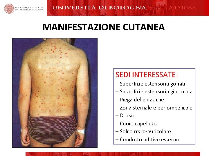 MANIFESTAZIONE CUTANEA SEDI INTERESSATE: – Superficie estensoria gomiti – Superficie estensoria ginocchia – Piega MANIFESTAZIONE CUTANEA SEDI INTERESSATE: – Superficie estensoria gomiti – Superficie estensoria ginocchia – Piega