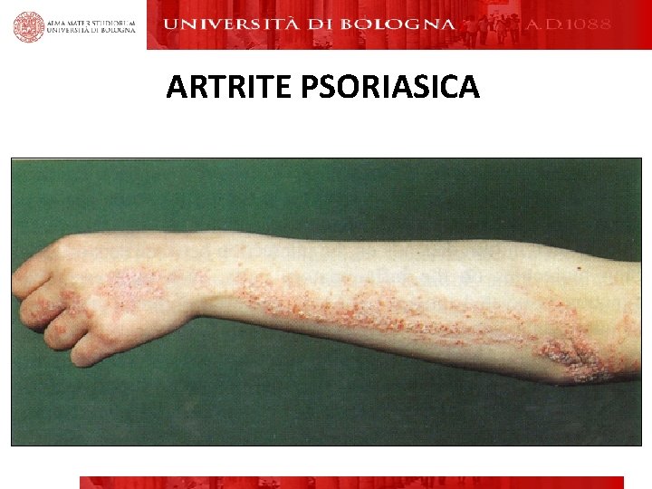 ARTRITE PSORIASICA ARTRITE PSORIASICA