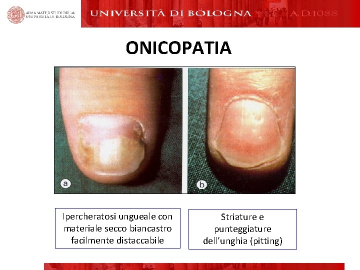 ONICOPATIA Ipercheratosi ungueale con materiale secco biancastro facilmente distaccabile Striature e punteggiature dell’unghia (pitting) ONICOPATIA Ipercheratosi ungueale con materiale secco biancastro facilmente distaccabile Striature e punteggiature dell’unghia (pitting)