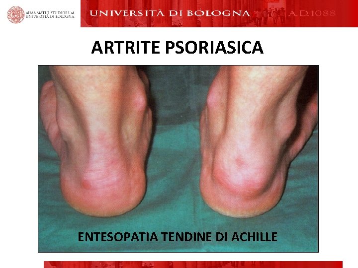 ARTRITE PSORIASICA ENTESOPATIA TENDINE DI ACHILLE ARTRITE PSORIASICA ENTESOPATIA TENDINE DI ACHILLE