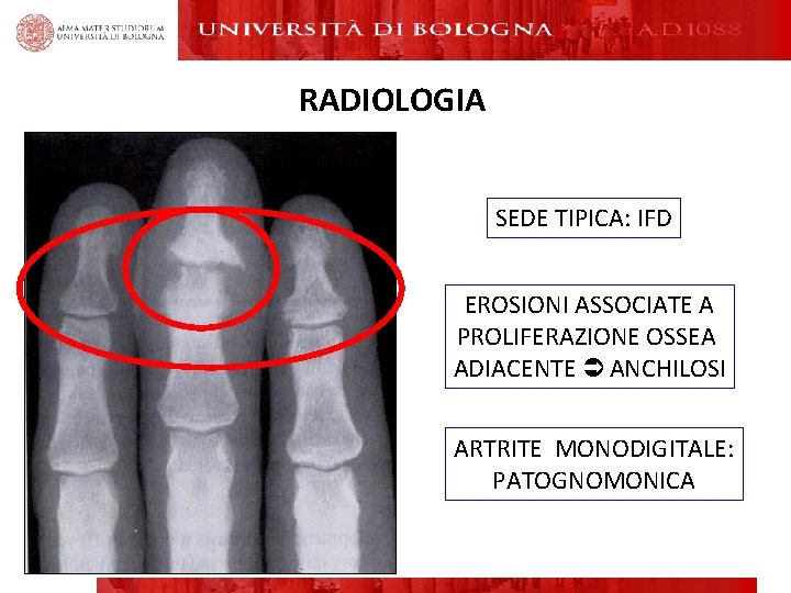 RADIOLOGIA SEDE TIPICA: IFD EROSIONI ASSOCIATE A PROLIFERAZIONE OSSEA ADIACENTE ANCHILOSI ARTRITE MONODIGITALE: PATOGNOMONICA RADIOLOGIA SEDE TIPICA: IFD EROSIONI ASSOCIATE A PROLIFERAZIONE OSSEA ADIACENTE ANCHILOSI ARTRITE MONODIGITALE: PATOGNOMONICA
