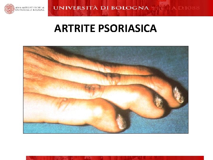 ARTRITE PSORIASICA ARTRITE PSORIASICA