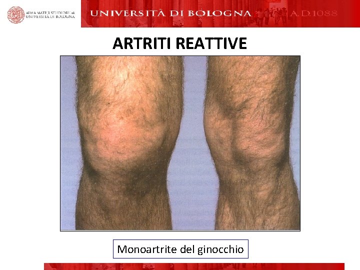 ARTRITI REATTIVE Monoartrite del ginocchio ARTRITI REATTIVE Monoartrite del ginocchio