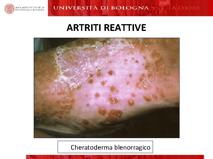 ARTRITI REATTIVE Cheratoderma blenorragico ARTRITI REATTIVE Cheratoderma blenorragico