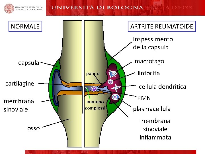 NORMALE ARTRITE REUMATOIDE inspessimento della capsula macrofago capsula panno cartilagine membrana sinoviale osso linfocita NORMALE ARTRITE REUMATOIDE inspessimento della capsula macrofago capsula panno cartilagine membrana sinoviale osso linfocita