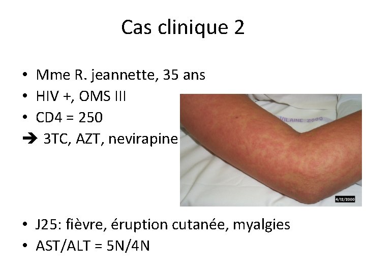 Cas clinique 2 • Mme R. jeannette, 35 ans • HIV +, OMS III