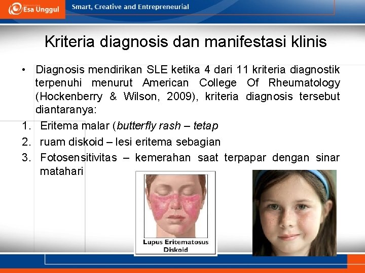 Kriteria diagnosis dan manifestasi klinis • Diagnosis mendirikan SLE ketika 4 dari 11 kriteria