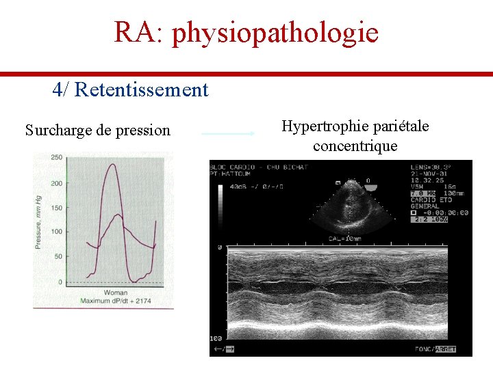 RA: physiopathologie 4/ Retentissement Surcharge de pression Hypertrophie pariétale concentrique Photo écho de RAC