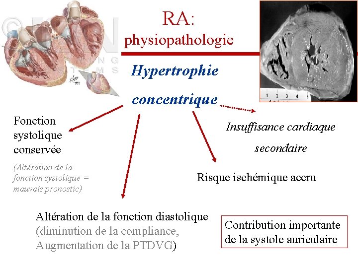 RA: physiopathologie Hypertrophie concentrique Fonction systolique conservée (Altération de la fonction systolique = mauvais