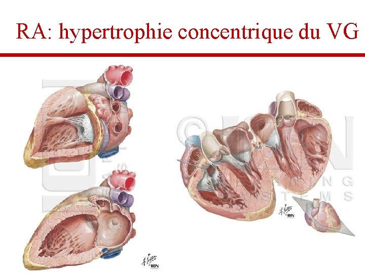 RA: hypertrophie concentrique du VG 