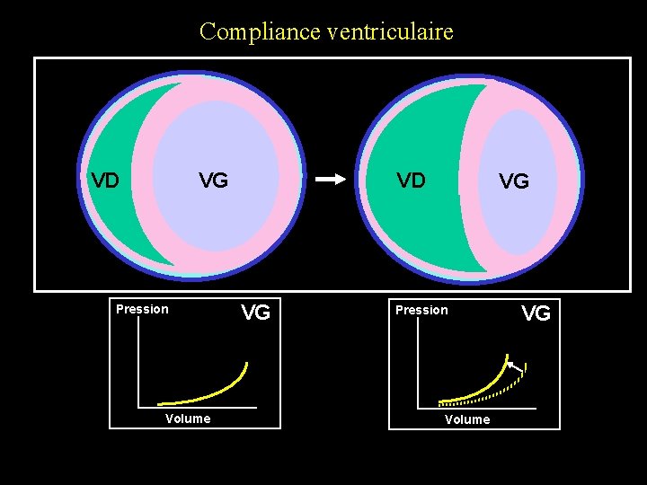 Compliance ventriculaire VD VG Pression Volume VD VG VG Pression Volume VG Compliance ventriculaire VD VG Pression Volume VD VG VG Pression Volume VG